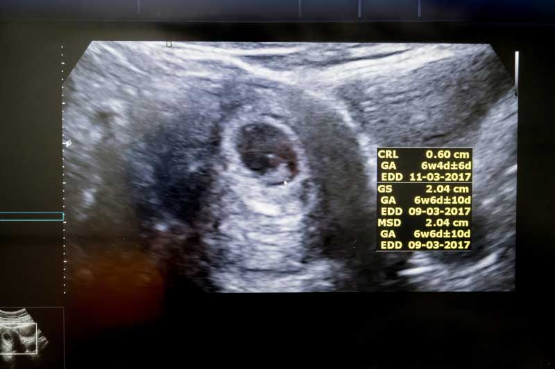 ultrazvuk u šestoj nedelji trudnoće