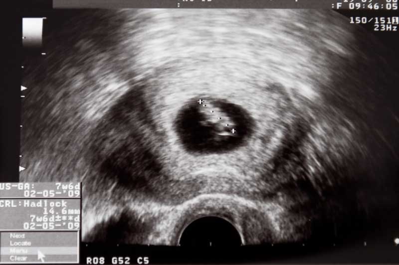 osma nedelja trudnoće ultrazvuk