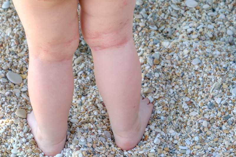 ekcem atopijski dermatitis kod beba