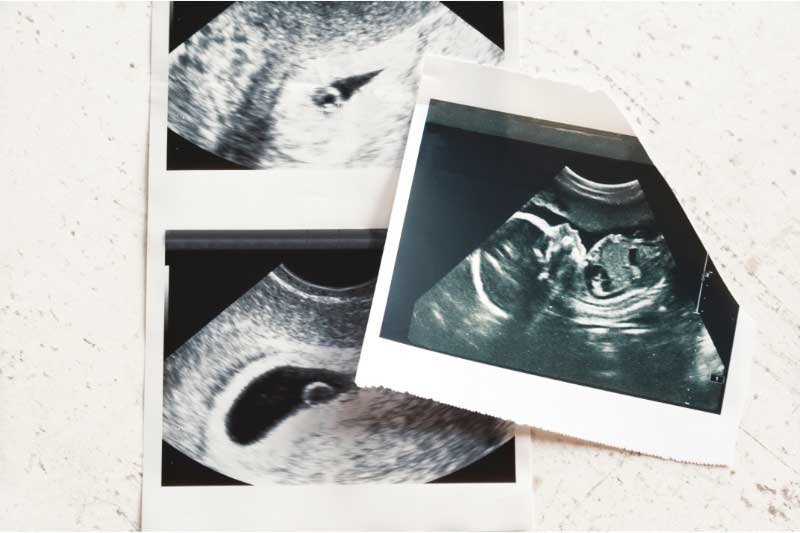 sedma nedelja trudnoće ultrazvuk