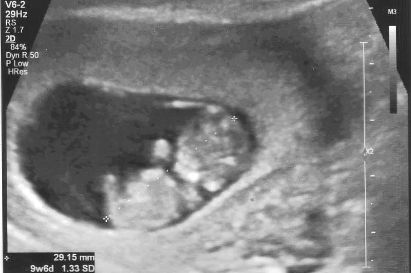 10 nedelja trudnoće ultrazvuk