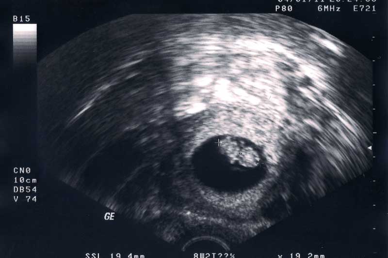 ultrazvuk u devetoj nedelji trudnoće