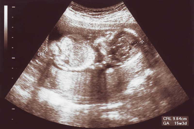 16 nedelja trudnoće ultrazvuk