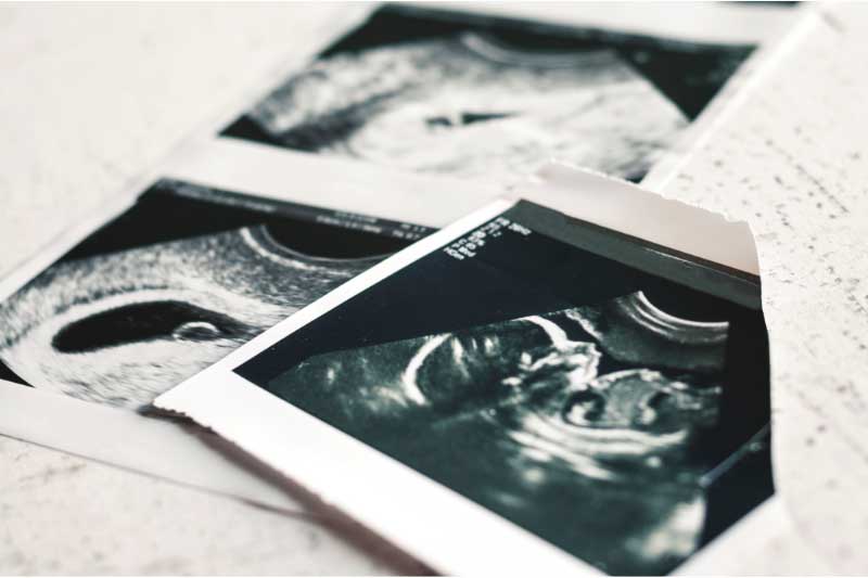 21 nedelja trudnoce ultrazvuk