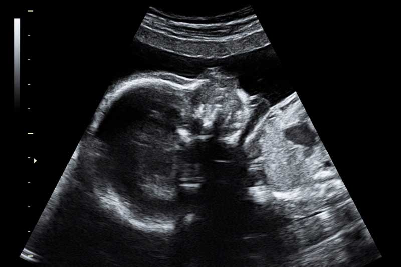 23 nedelja trudnoce ultrazvuk