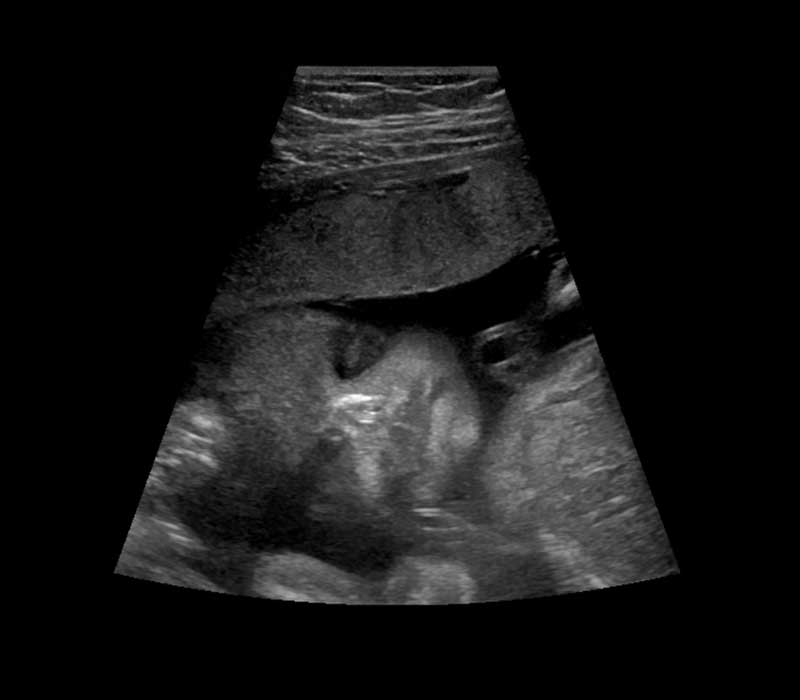 25 nedelja trudnoće ultrazvuk