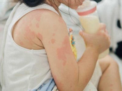 alergija kod beba