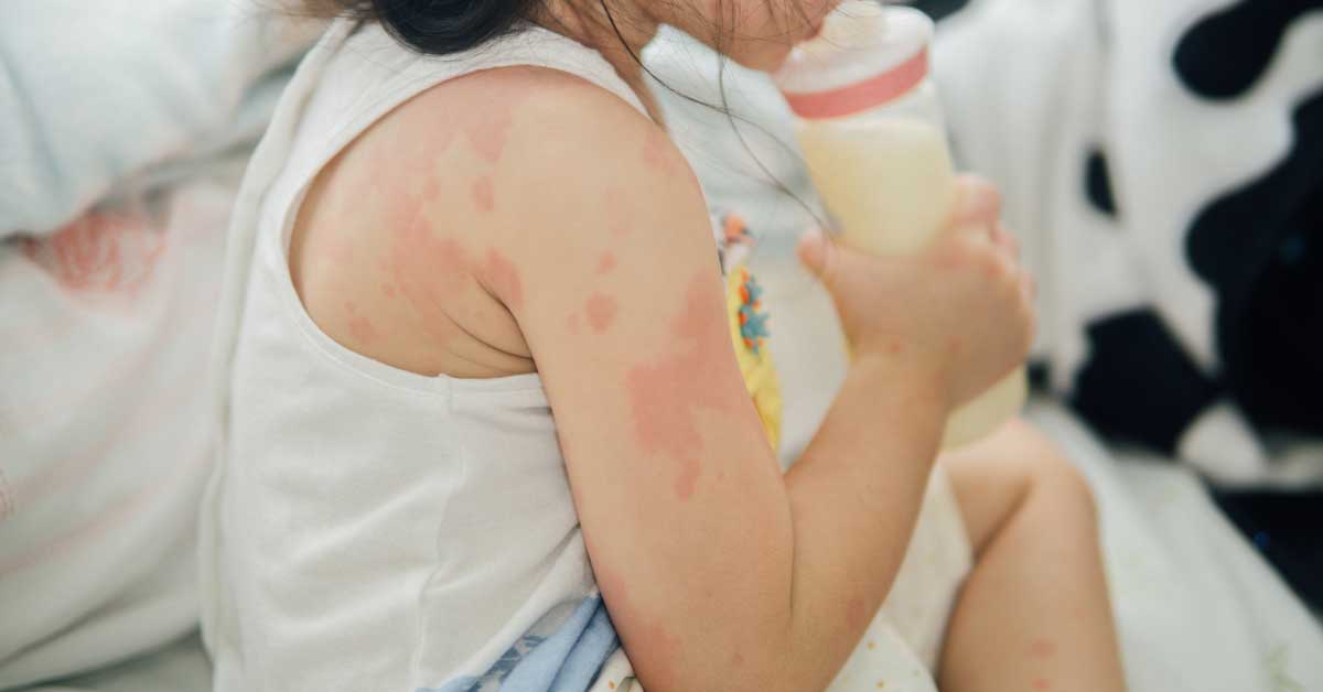 alergija kod beba