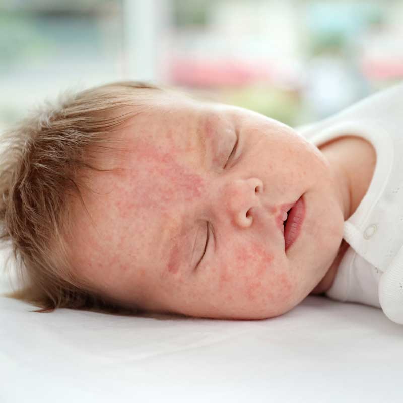alergija kod beba simptomi