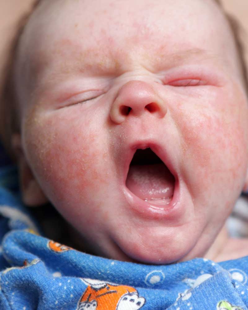 konjuktivitis kod beba simptomi